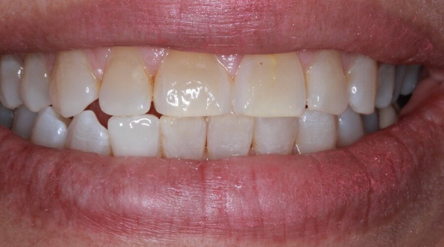 Real Smile Transformation Image