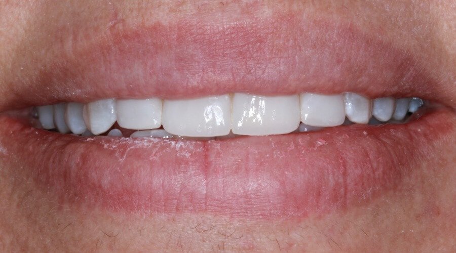 Real Smile Transformation Image