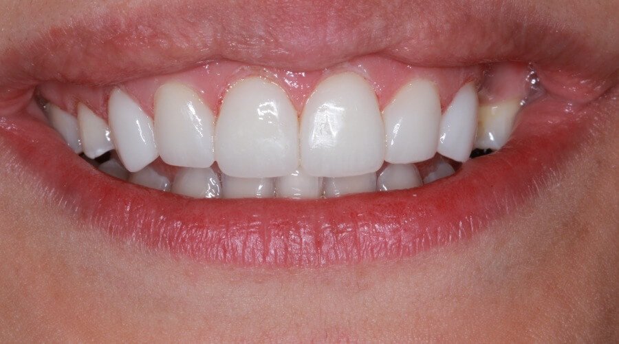 Real Smile Transformation Image