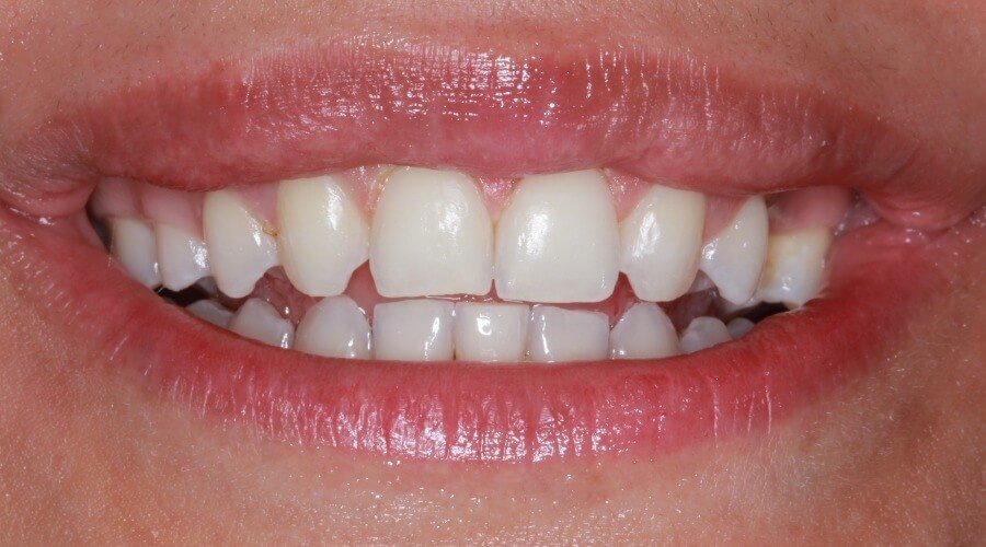 Real Smile Transformation Image