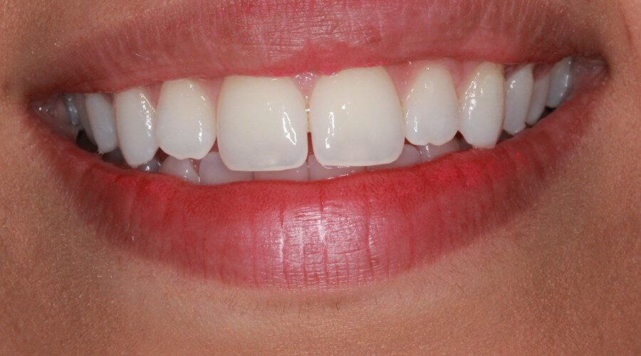 Real Smile Transformation Image