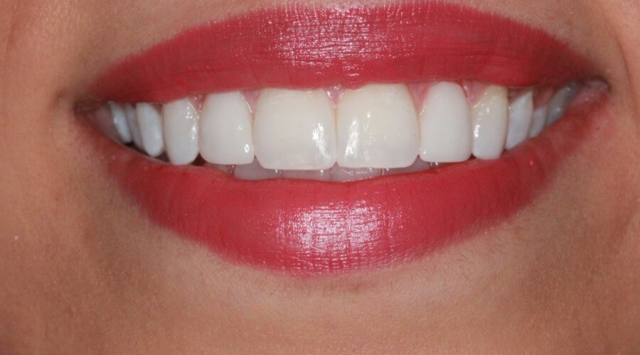 Real Smile Transformation Image