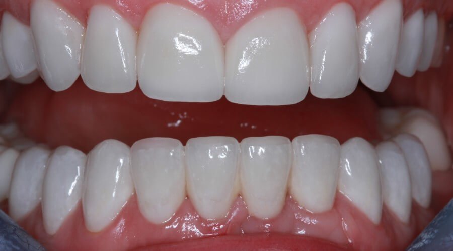 Real Smile Transformation Image