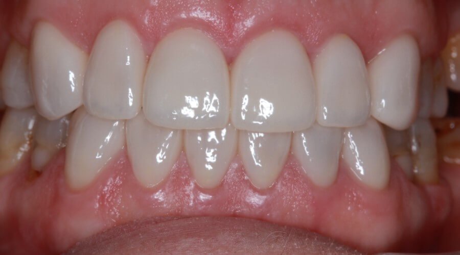 Real Smile Transformation Image