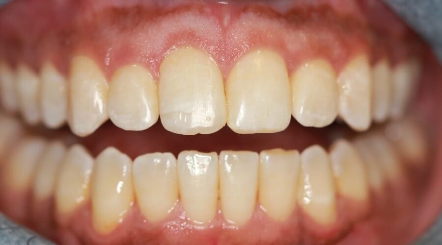 Real Smile Transformation Image