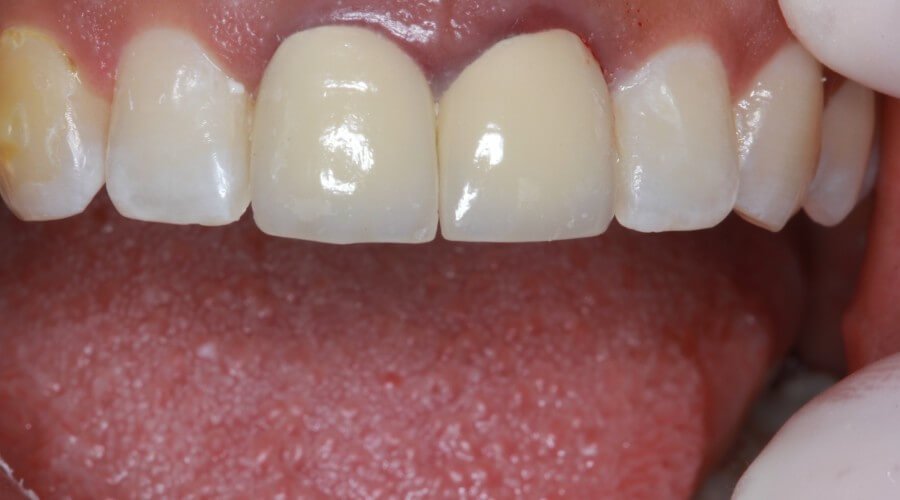 Real Smile Transformation Image