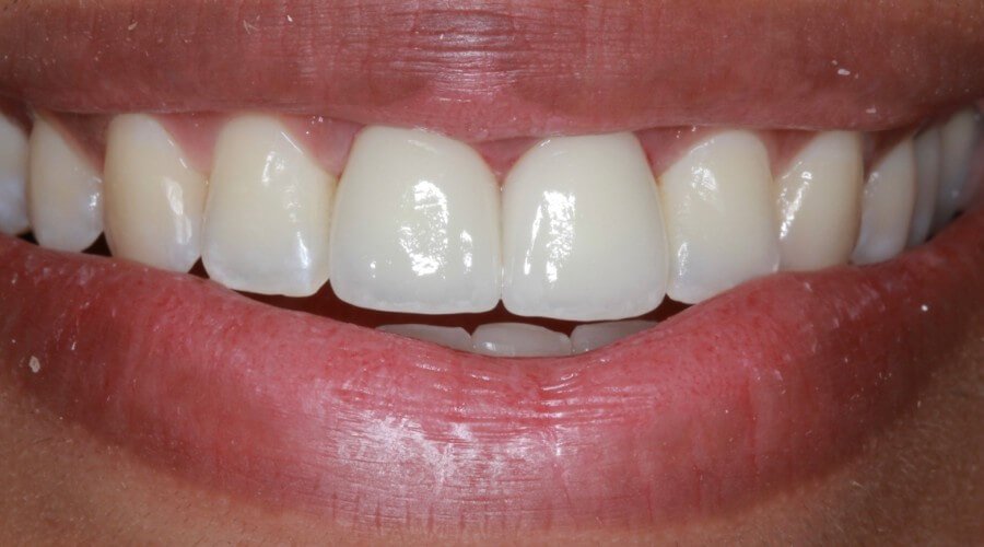 Real Smile Transformation Image