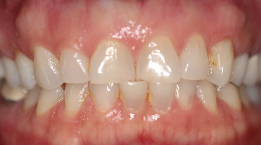 Real Smile Transformation Image