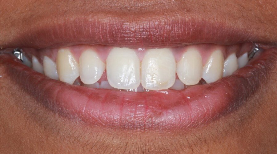 Real Smile Transformation Image