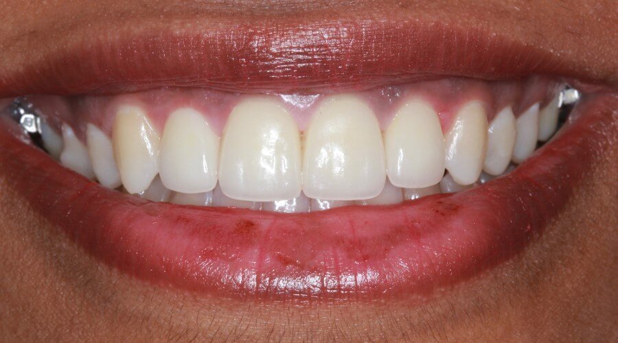 Real Smile Transformation Image