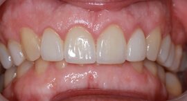 Real Smile Transformation Image