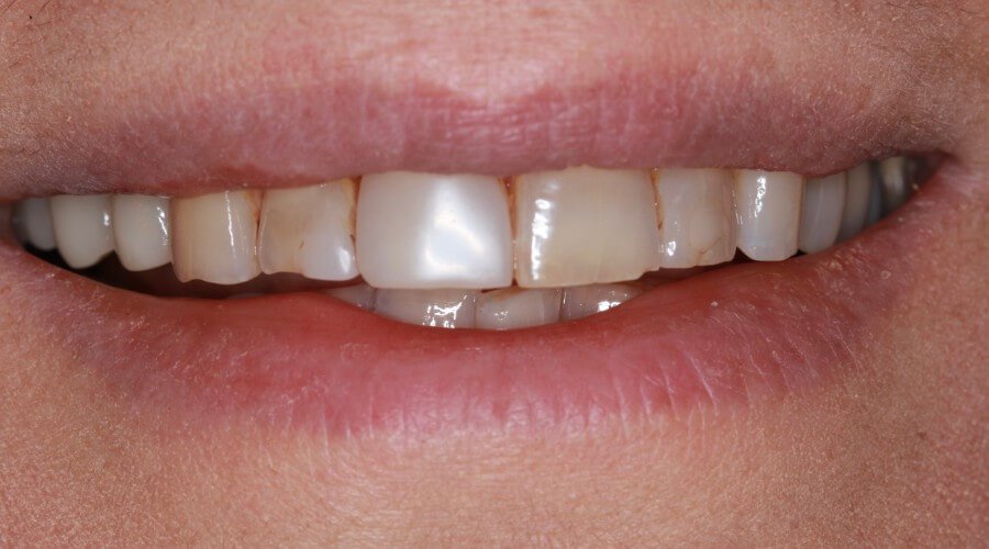 Real Smile Transformation Image