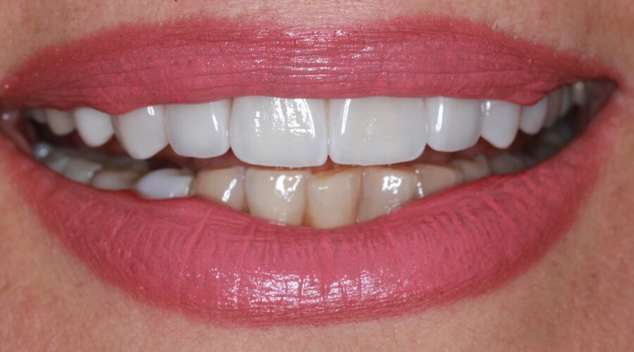 Real Smile Transformation Image