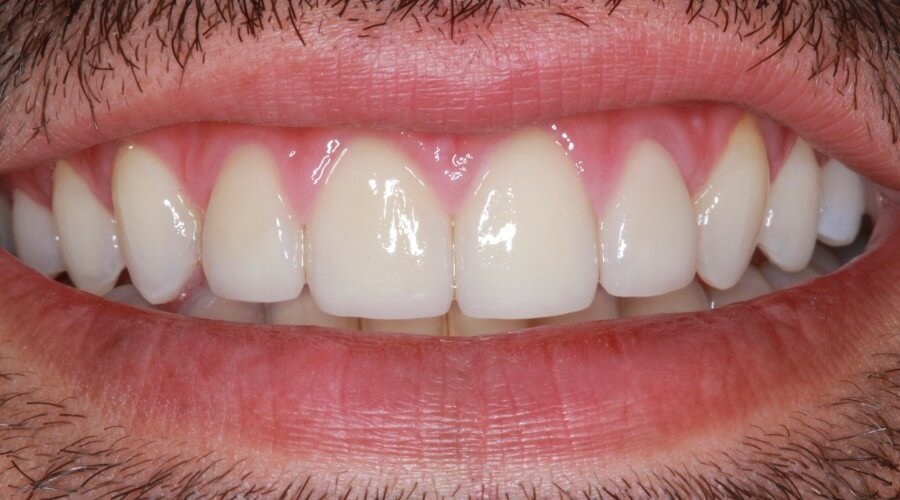 Real Smile Transformation Image