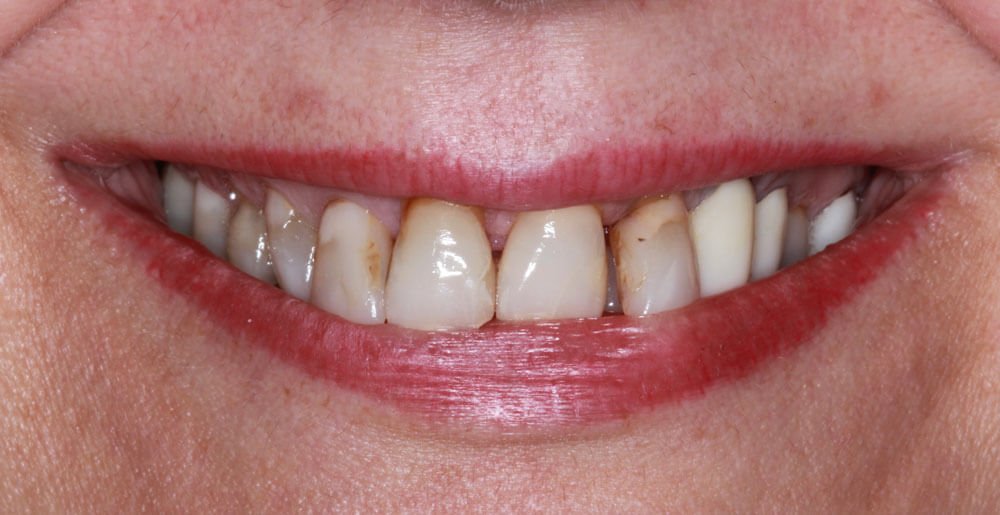 Real Smile Transformation Image