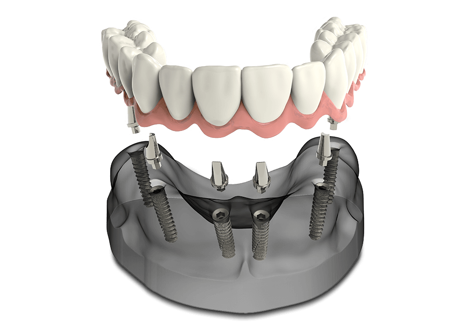 acrylic overdenture - removable and fixed